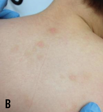 Urticaria Pigmentosa Pictures: Identify Symptoms