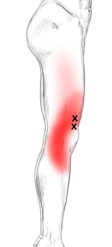 Vastus Lateralis Relief Guide