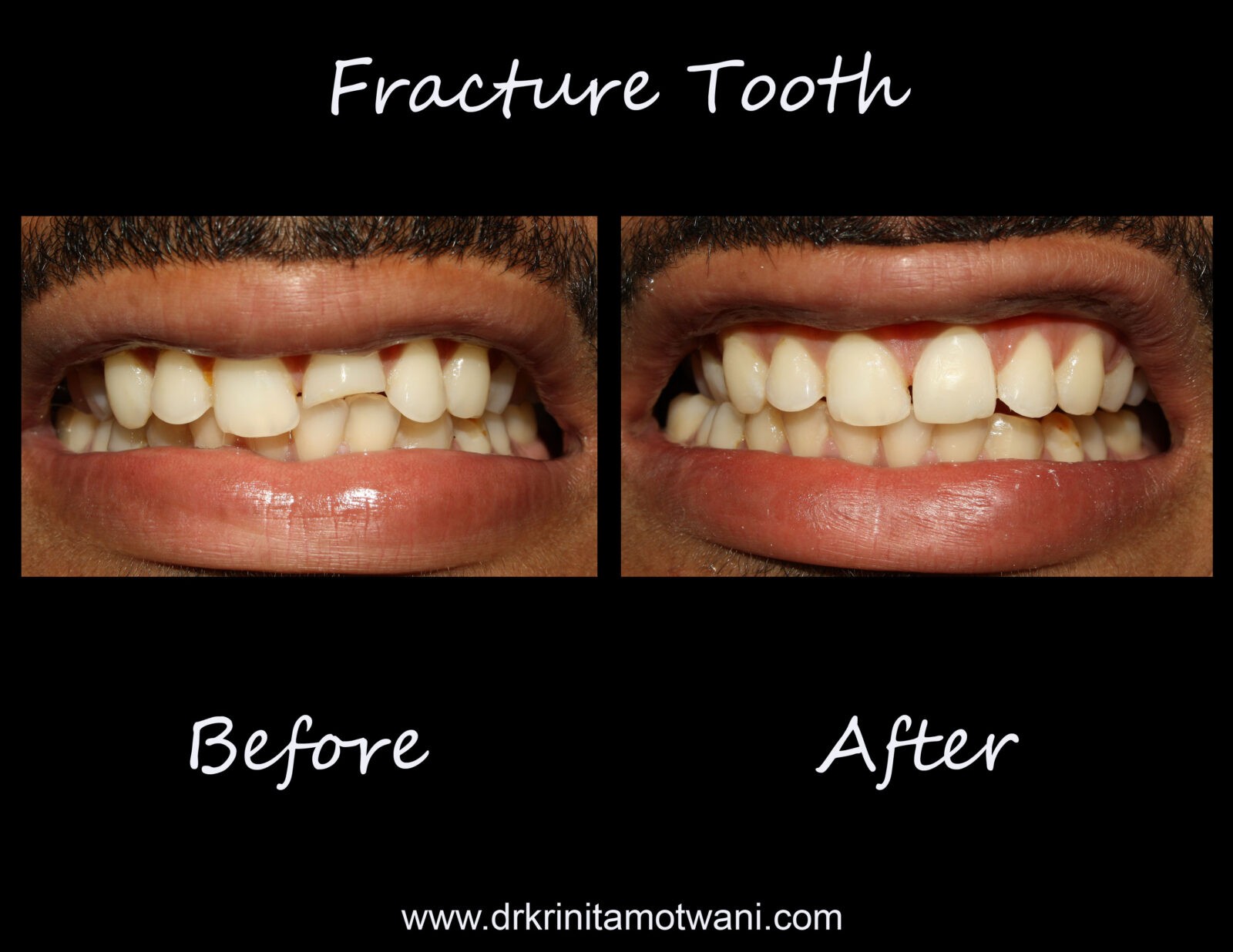 Vertically Fractured Tooth Repair