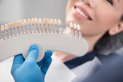 What Are Composites Vs Veneers? Best Option Guide