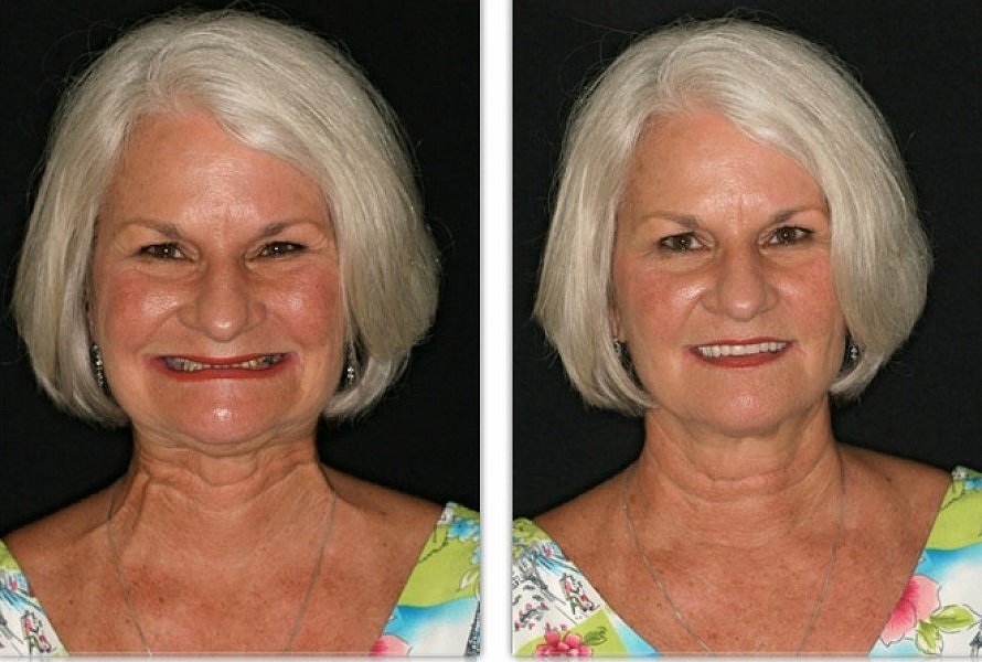 What Are Dentures For Young Women? Smile Solutions