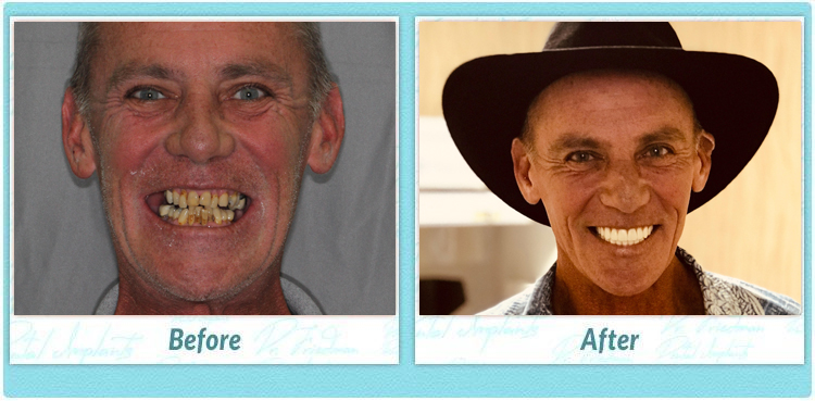 What Are Oneday Dental Implants? Instant Smile Solution