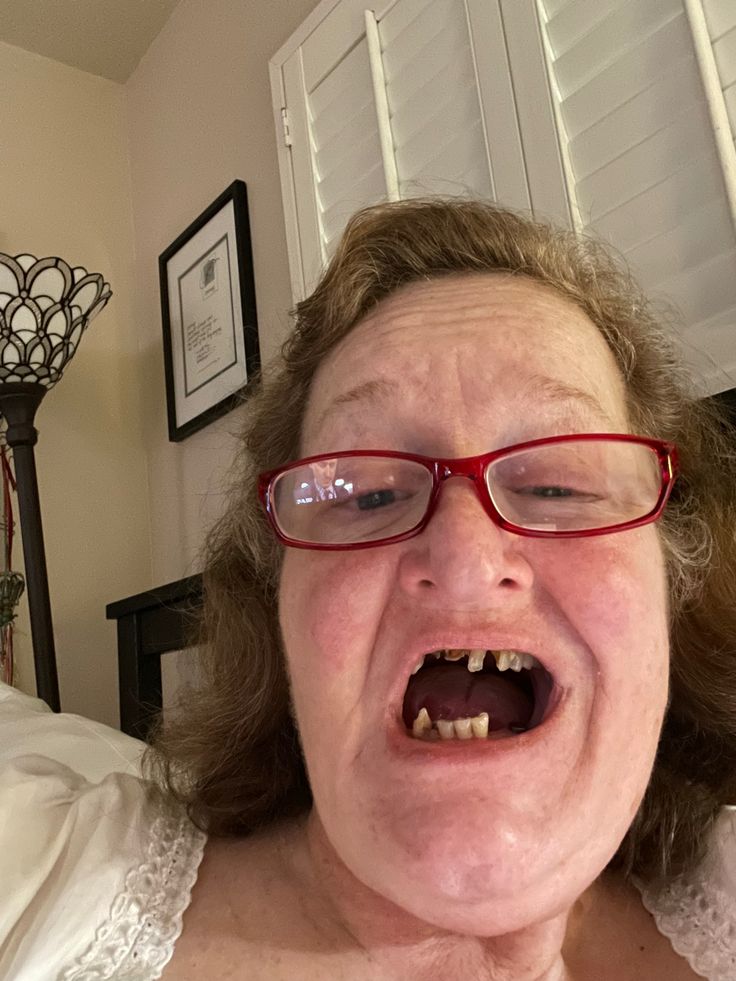 What Are Pegged Teeth? Fixing Smile Issues What Are Pegged Teeth? Fixing Smile Issues