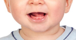 What Causes 10 Months No Teeth? Expert Advice What Causes 10 Months No Teeth? Expert Advice