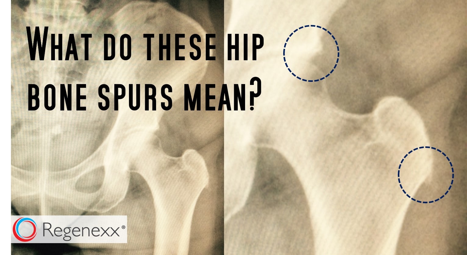What Causes Bone Spur Heel Pain? Find Relief