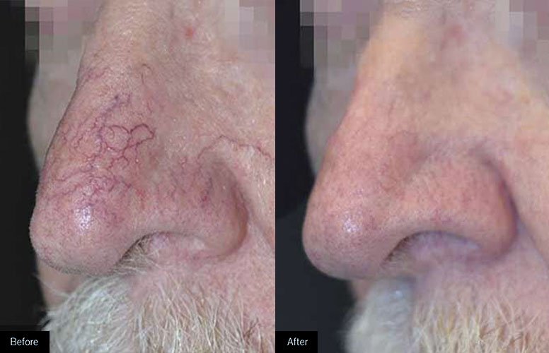 What Causes Broken Blood Vessel In Lip? Fast Relief
