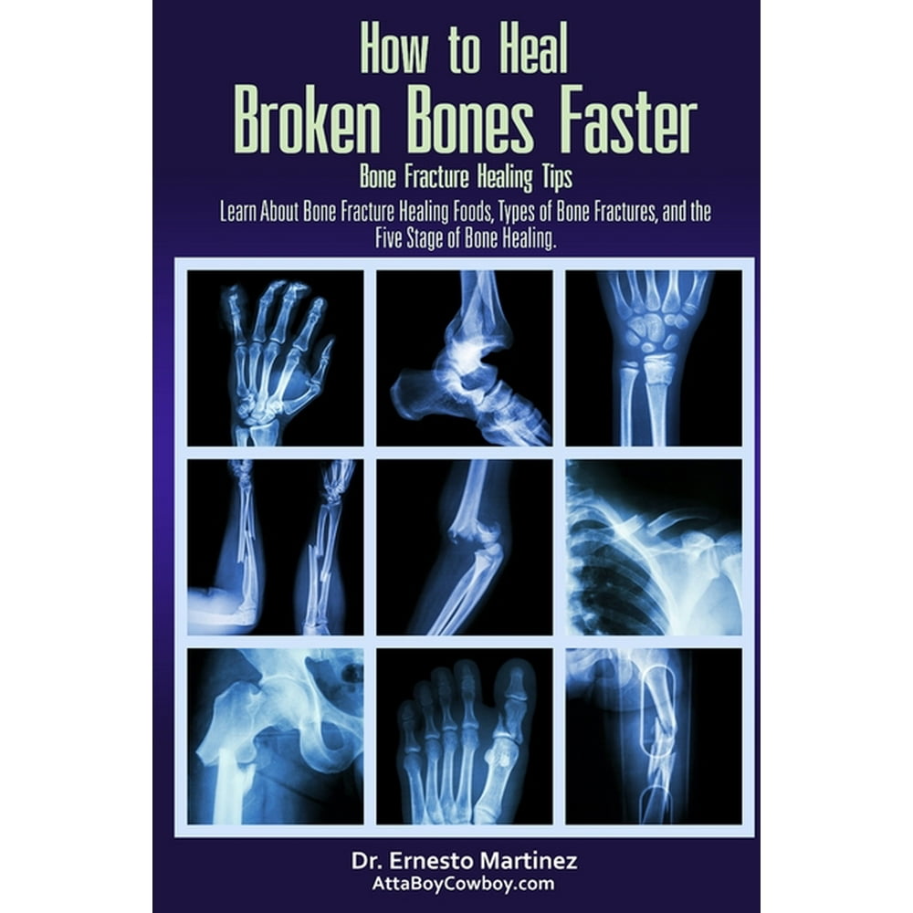 What Causes Bruise Or Fracture? Healing Tips What Causes Bruise Or Fracture? Healing Tips