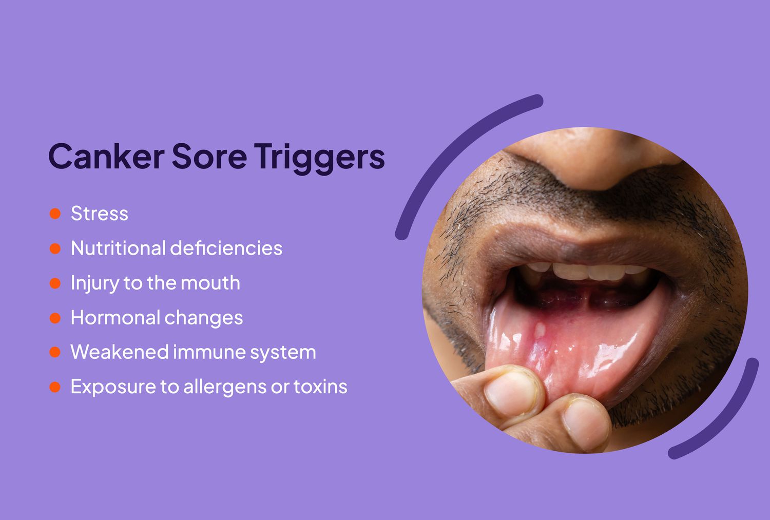 What Causes Canker Sore On Tonsil? Quick Relief