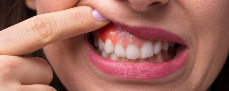 What Causes Cut On Gum Behind Molar? Heal Faster What Causes Cut On Gum Behind Molar? Heal Faster