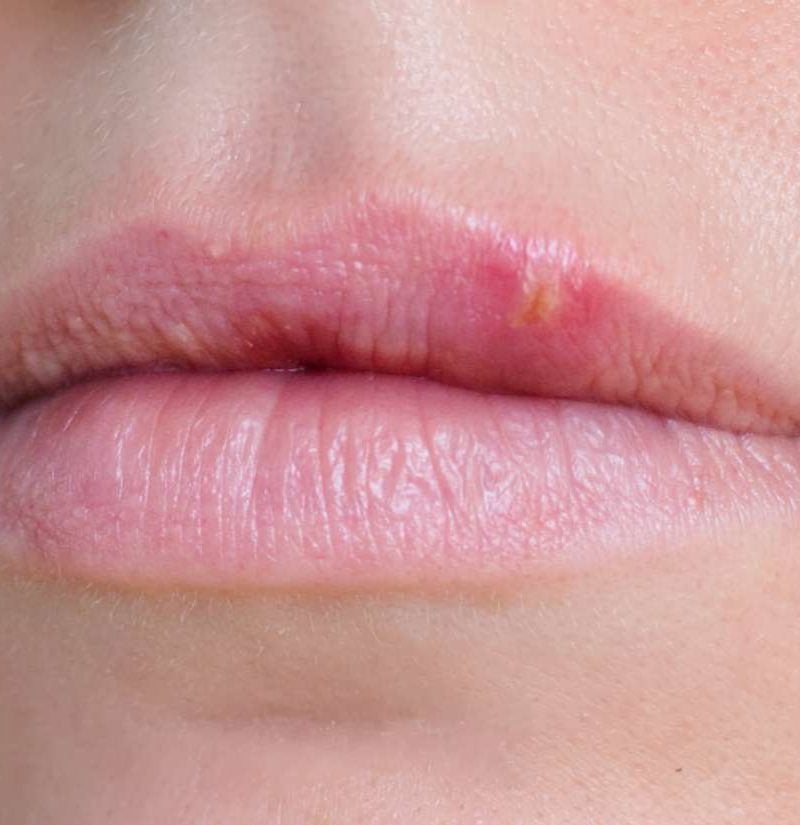 What Causes Granito En El Labio? Remedies Inside