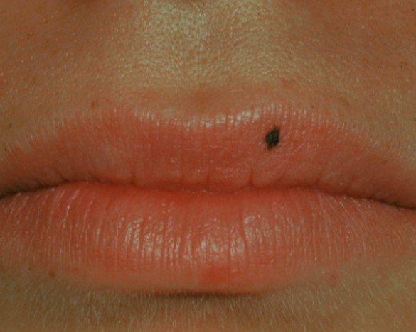 What Causes Labial Melanotic Macule? Removal Guide