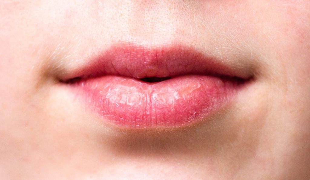 What Causes Maladie Des Lèvres? Fast Relief Solutions