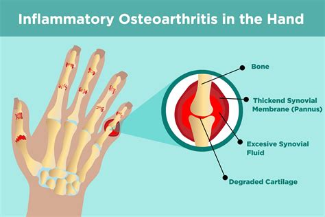 What Causes Osteoarthritis? Hand Pain Relief What Causes Osteoarthritis? Hand Pain Relief