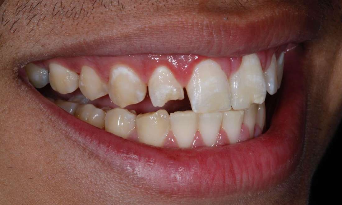What Fixes Bridge Work On Front Teeth? Cosmetic Solutions