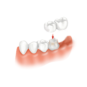 What Is Cantilever Bridge? Restore Smiles Easily