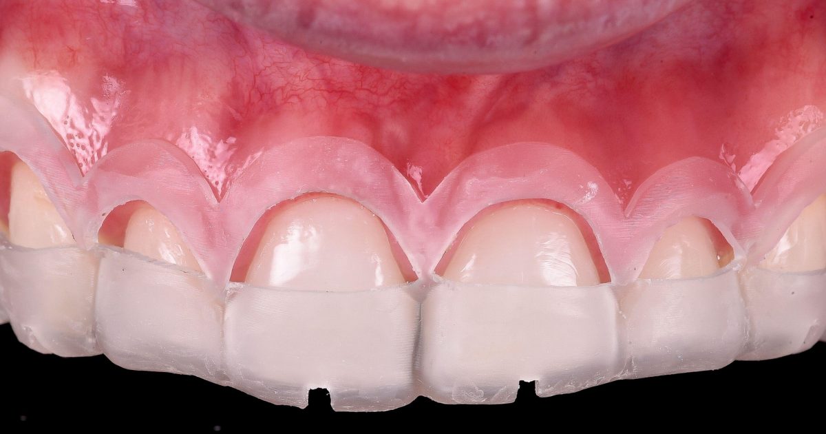 What Is Crown Lengthening For Crown? Smile Restoration