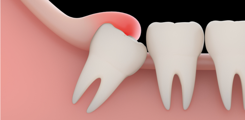 What Is Dental Operculum Treatment? A Solution Guide