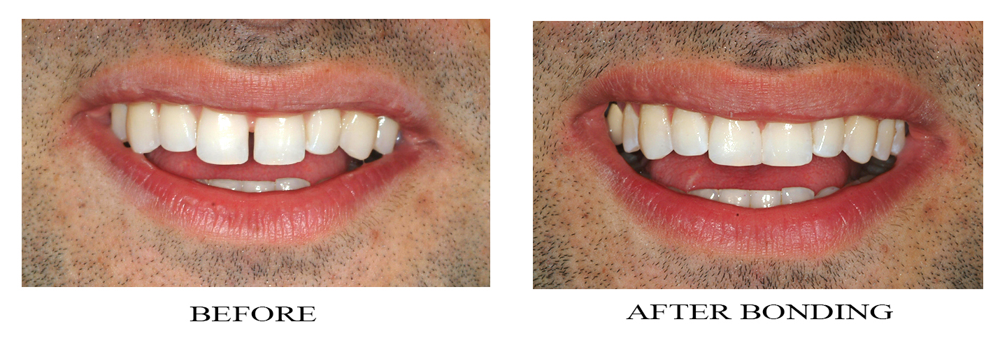 What Is Gap Dental Bonding? Fix Smile Gaps