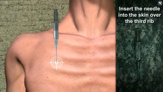 What Is Needle Decompression Of Pneumothorax? A Lifesaver