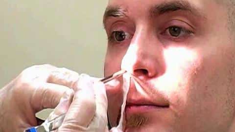 What Is Nose Cauterization? Permanent Fix Explained