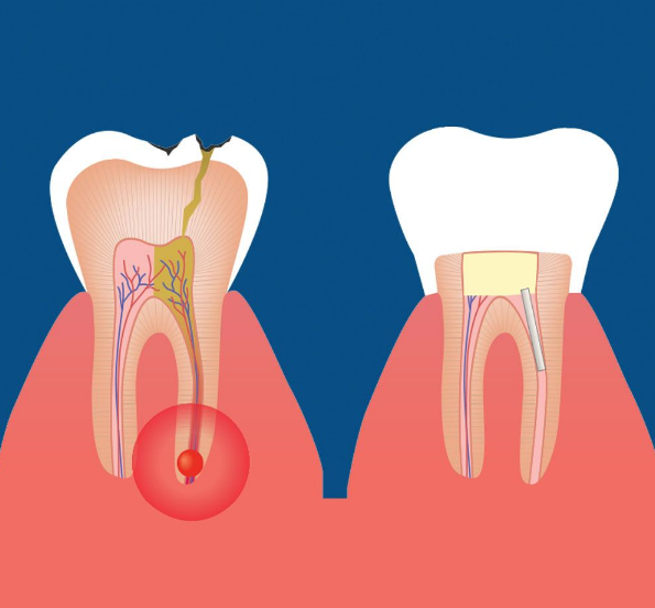 What Is Root Canal Affordable? Cost Savings Guide