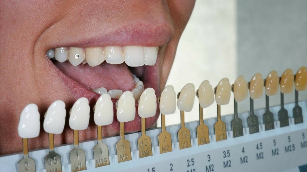 What Is Tooth Colour Chart? Find Your Shade