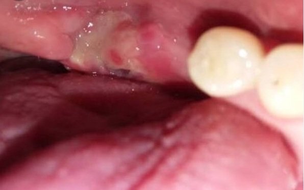What Is White Stuff After Tooth Extraction? Healing Guide