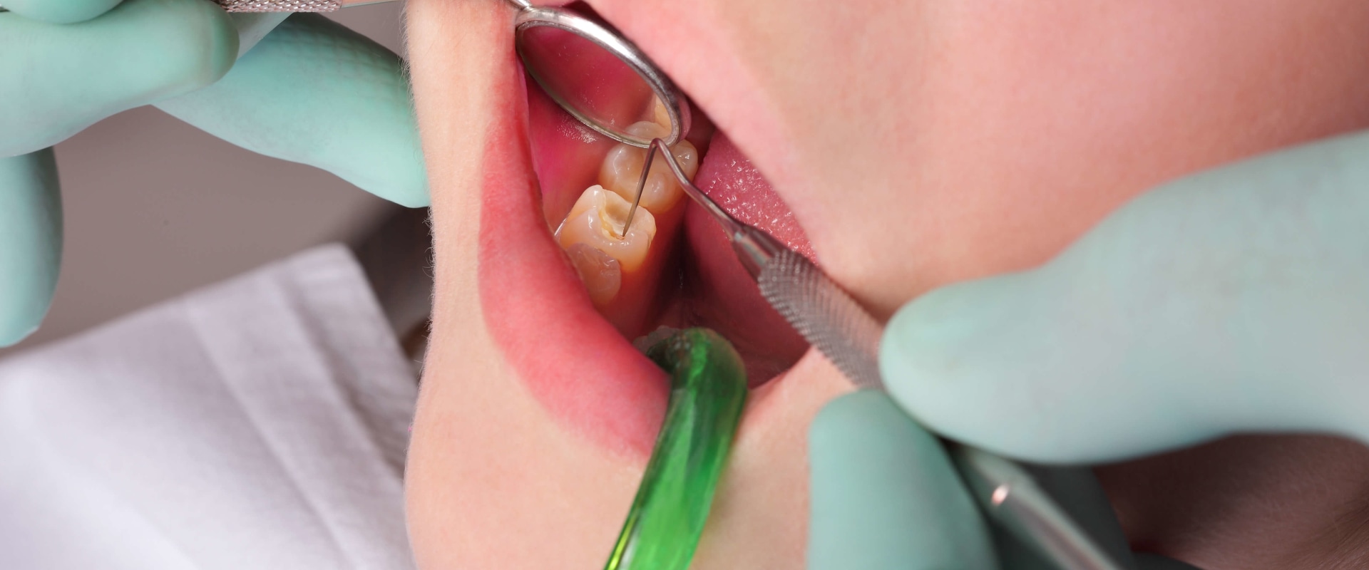 What Tools Do Dentists Use? Extraction Made Easy