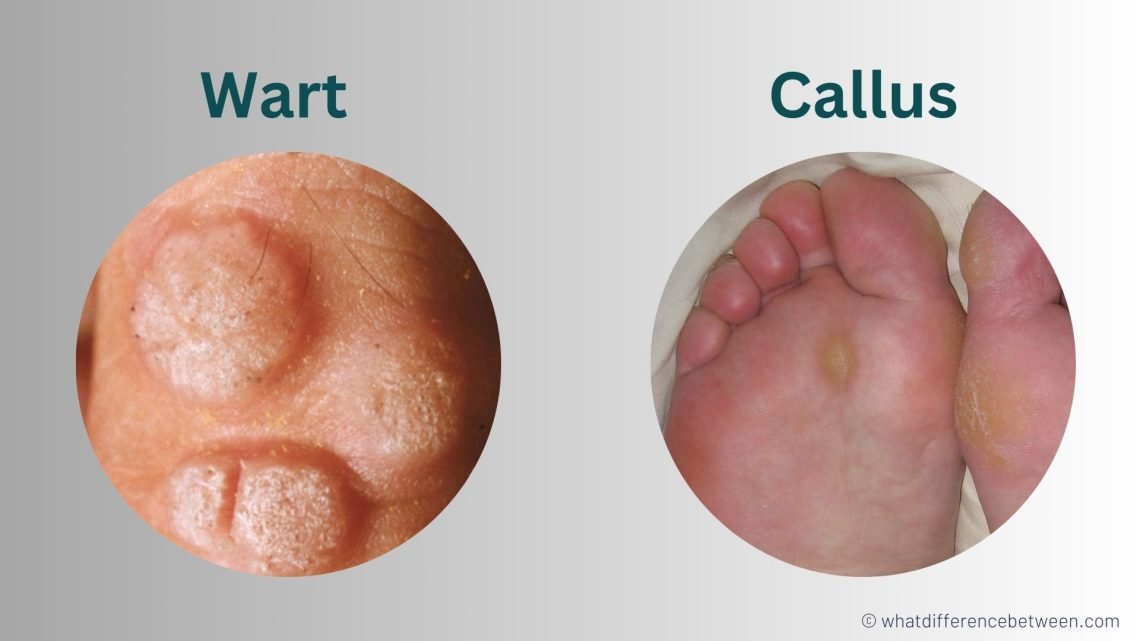 What's Pimple Vs Wart? Spot Difference