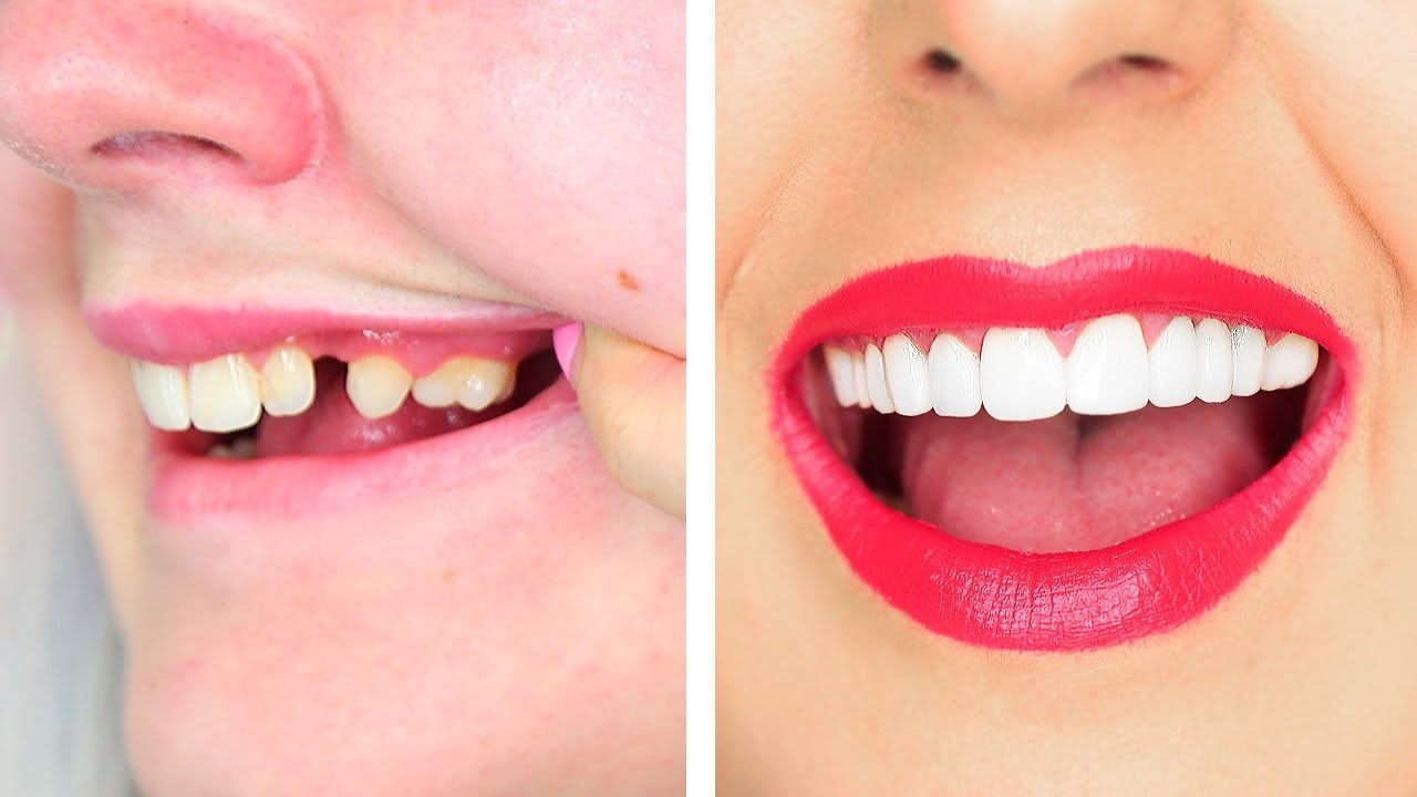 What's Veneers Price Per Tooth? Get Quote