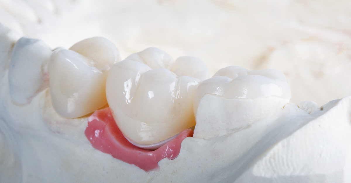 When Do Dental Crowns Become Necessary? Saving Tips