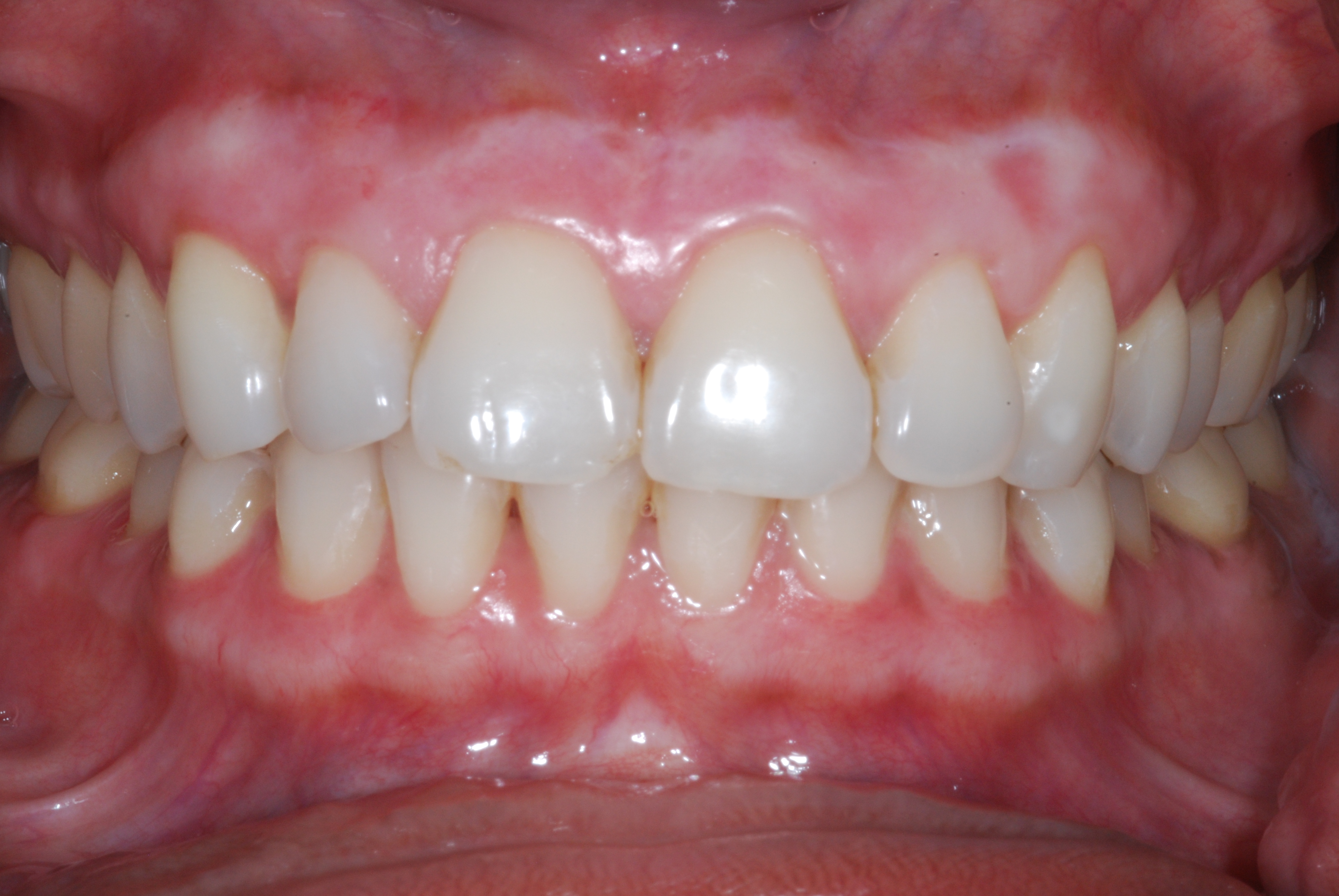 White Gums After Whitening: Causes Revealed