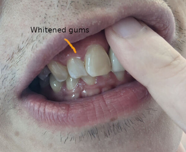 White Gums After Whitening