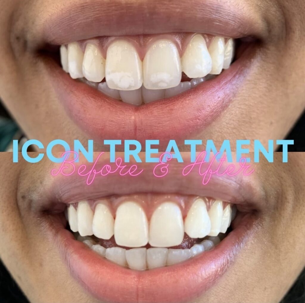 White Spots On Teeth Removal