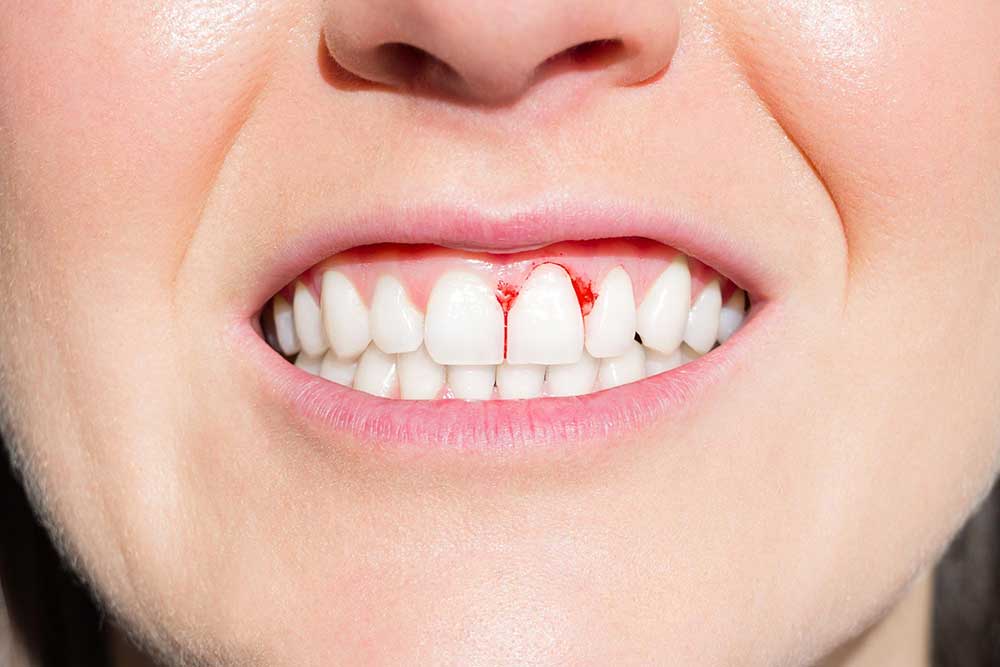 Why Bleeding Gums Happen? Fix Flossing Issues