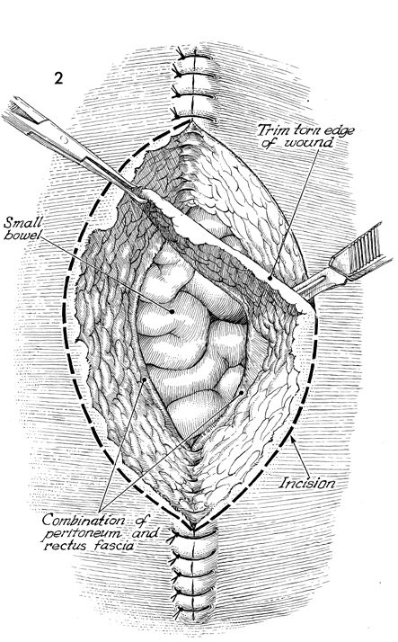 Wound Dehiscence And Evisceration